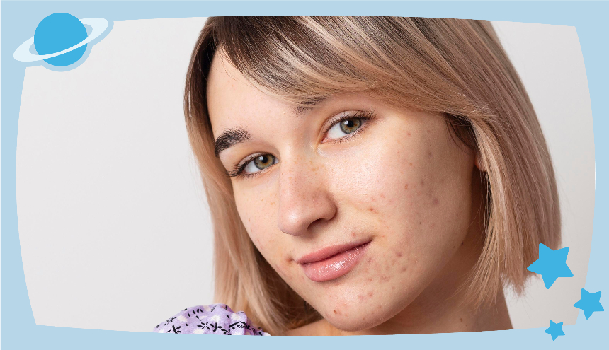 Bekas Jerawat Bikin Gak Pede? Simak Urutan Skincare untuk Menghilangkan Bekas Jerawat yang Efektif!